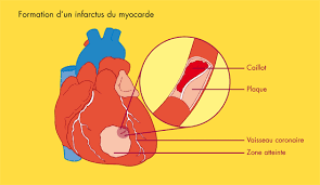 Infarctus Du Myocarde formation