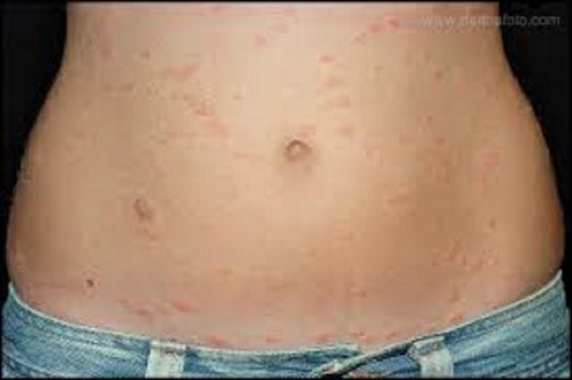 Remède naturel psoriasis : 11 conseils pour améliorer votre vie quotidienne !