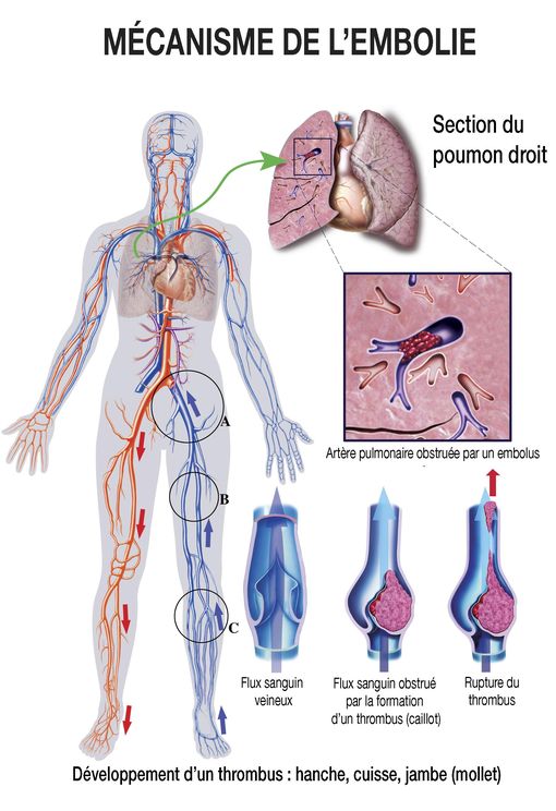 Embolie Pulmonaire