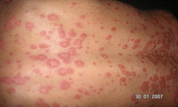 Les symptômes du psoriasis