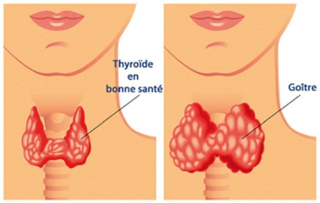 thyroïde