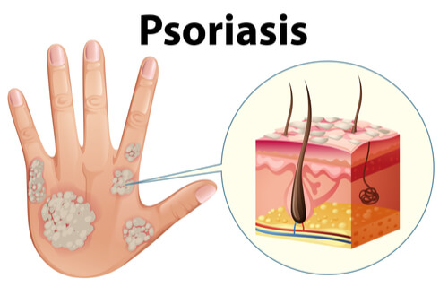 Causes du psoriasis