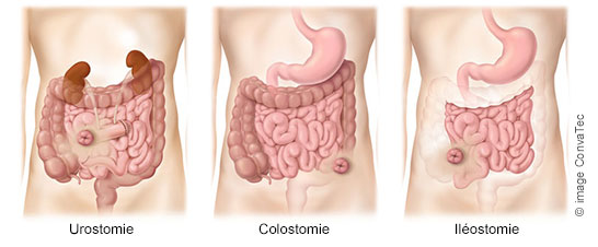 Traitement de la maladie de Crohn