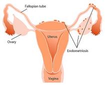 endometriose