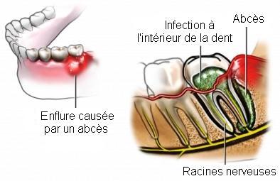 abcès Dentaire