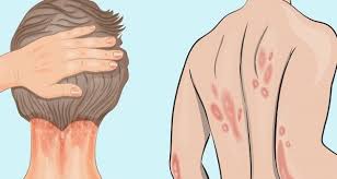 Causes du psoriasis