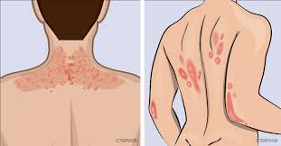 Causes du psoriasis