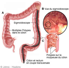 cancers du côlon