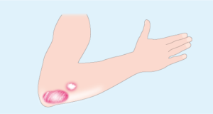 Les symptômes du psoriasis