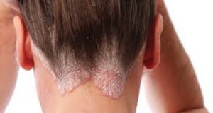le psoriasis