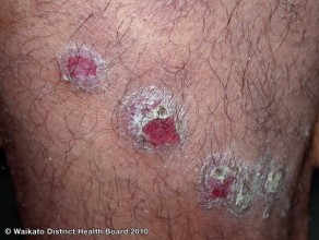 Les symptômes du psoriasis