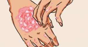 Causes du psoriasis