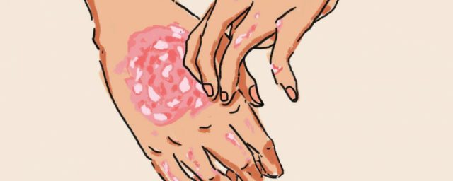 Causes du psoriasis