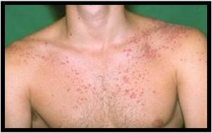 types de psoriasis