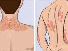 types de psoriasis