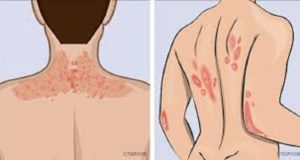 types de psoriasis