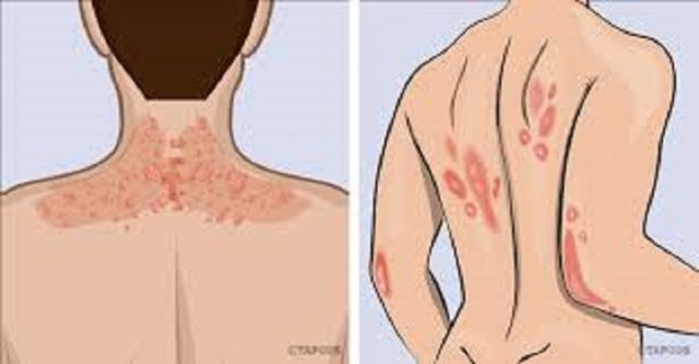 types de psoriasis