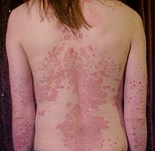 types de psoriasis