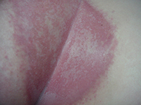 types de psoriasis