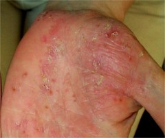 types de psoriasis