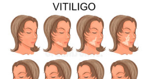 Vitiligo