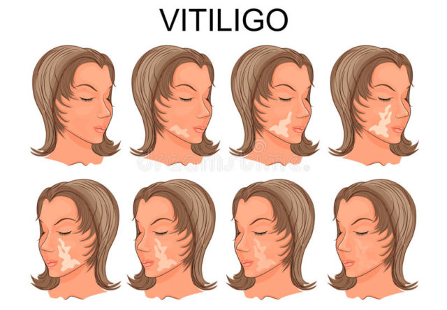 Vitiligo