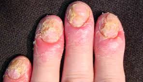 types de psoriasis