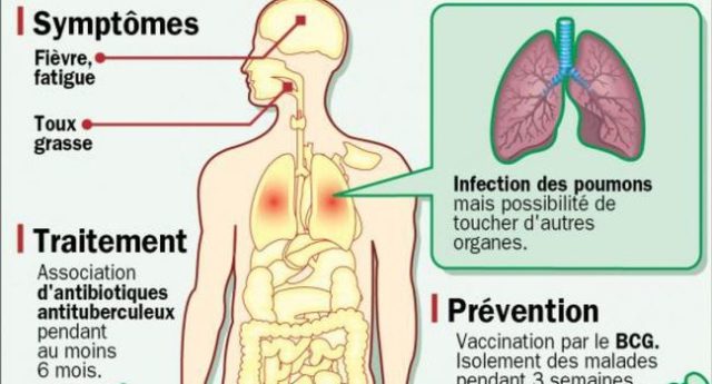 Tuberculose