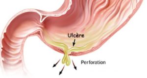 Ulcère gastrique et duodénal