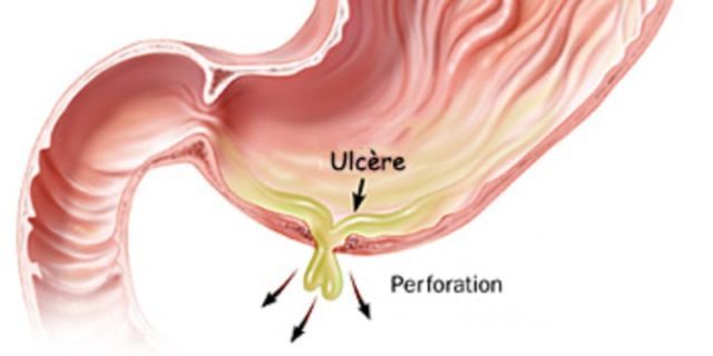 Ulcère gastrique et duodénal