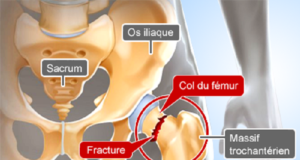 Fracture Du Col Du Fémur