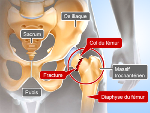 Fracture Du Col Du Fémur