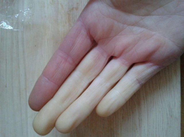 Maladie de Raynaud